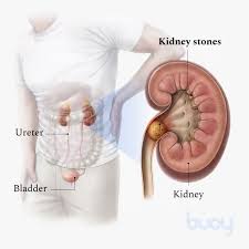 ಕಿಡ್ನಿಯಲ್ಲಿ ಕಲ್ಲು ಇದೆಯೋ ಅಥವಾ ಇಲ್ಲವೋ ..?